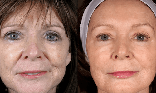 non surgical facelift before after skin tightening mississauga oakville